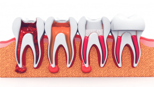 Makaleler 26 Ankara Endodonti Tedavisi