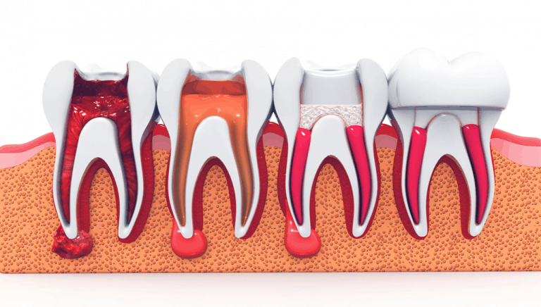 Ankara Endodonti Tedavisi
