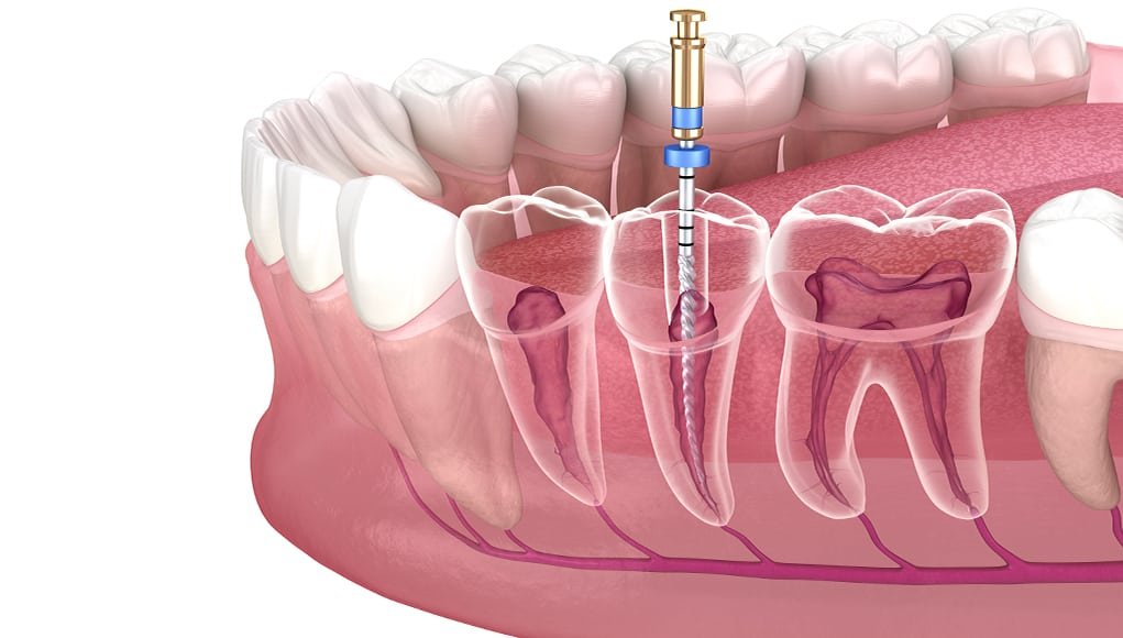 Ankara Endodonti Tedavisi 1 Ankara Endodonti Tedavisi