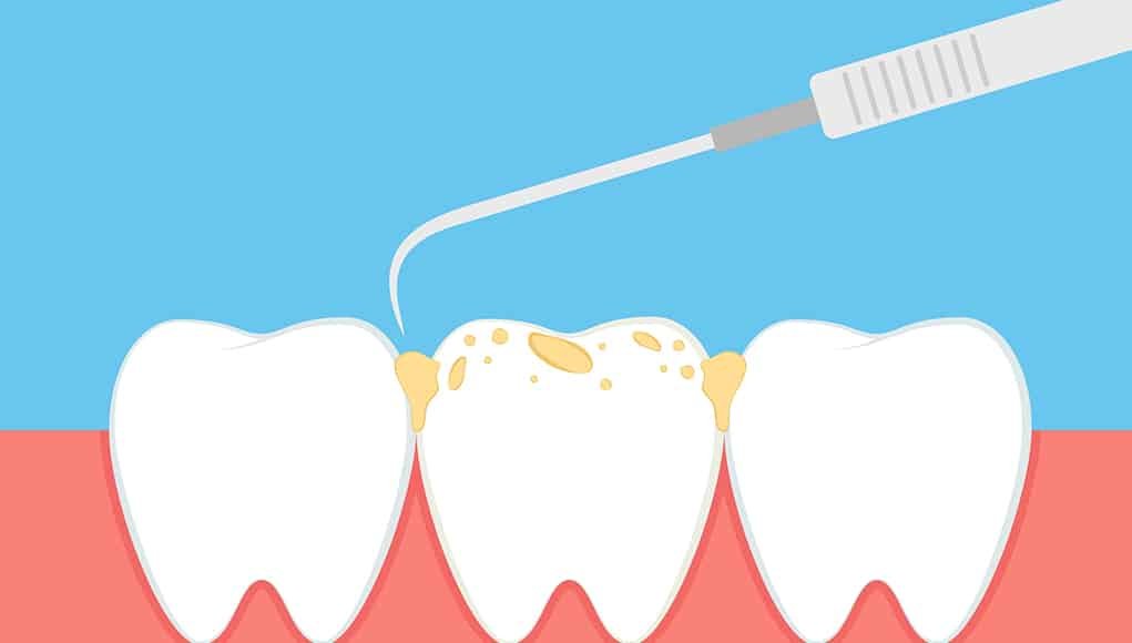 Diş Taşı Nedir ? 1 Diş Taşı Temizleme