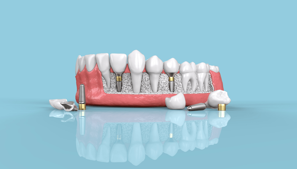 Implant Markalarini Taniyalim 1 İmplant Markalarını Tanıyalım