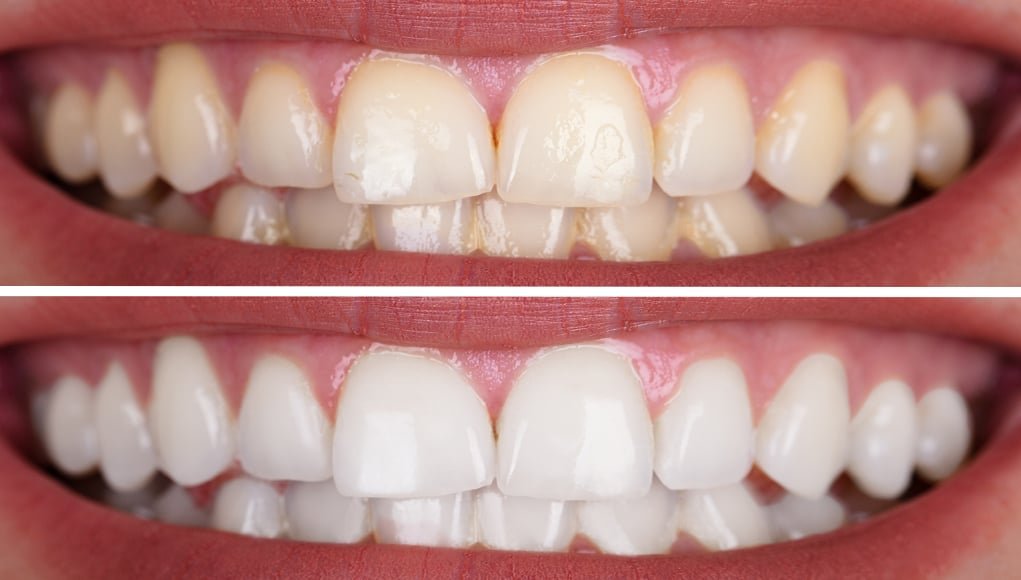 Kızılay Diş Beyazlatma 1 Kızılay Diş Beyazlatma - Dr. Cüneyt Bosna