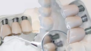 Makaleler 10 Implant tedavisi