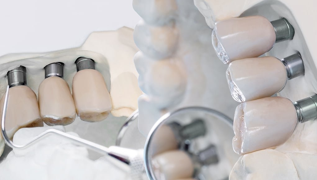 İmplant 1 Implant tedavisi