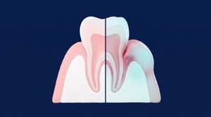Diş eti iltihabı (gingivitis)
