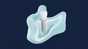Makaleler 6 Diş implantı kemik kesiti