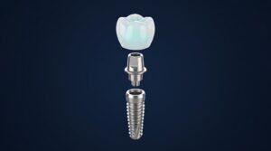 Makaleler 17 Diş implantı yapısı